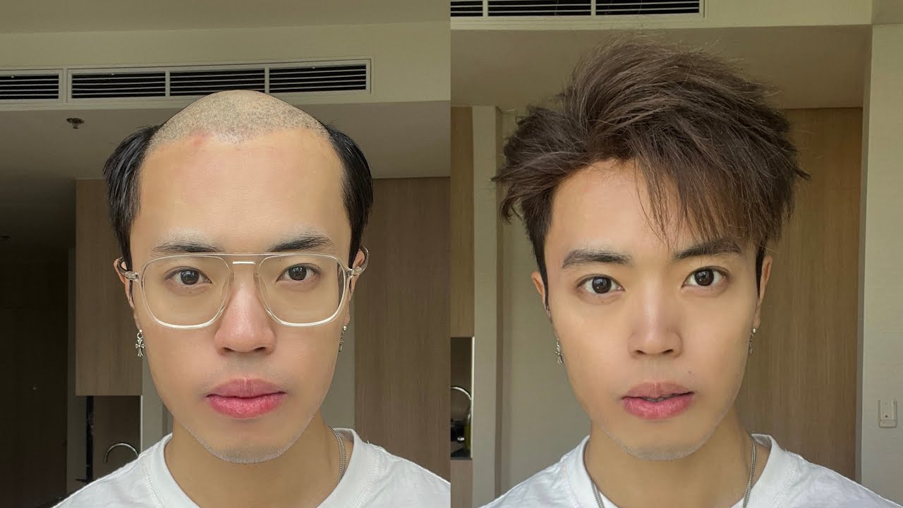 How Should A 30 year old Bald Boy With Hair Loss Counterattack In Life how-should-a-30-year-old-bald-boy-with-hair-loss-counterattack-in-life
