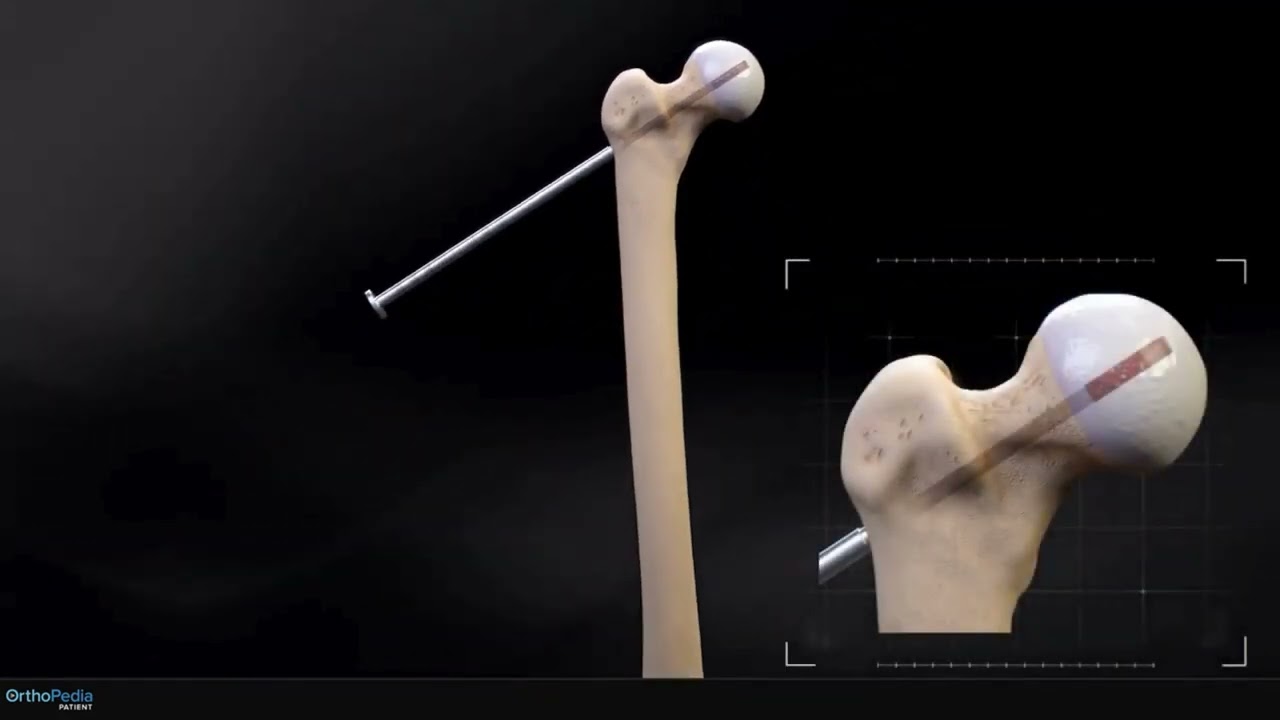 Hip AVN Treatment: Expandable Reamer Core Decompression Animation 