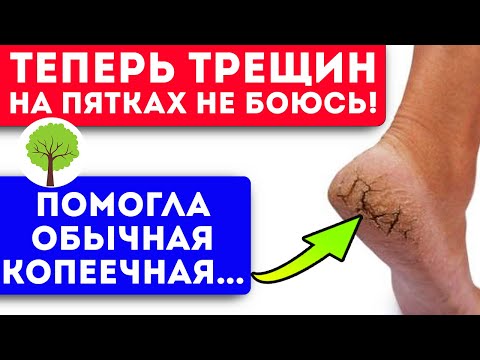 Забыла про трещины на пятках! Уйдут навсегда от этого простого средства!