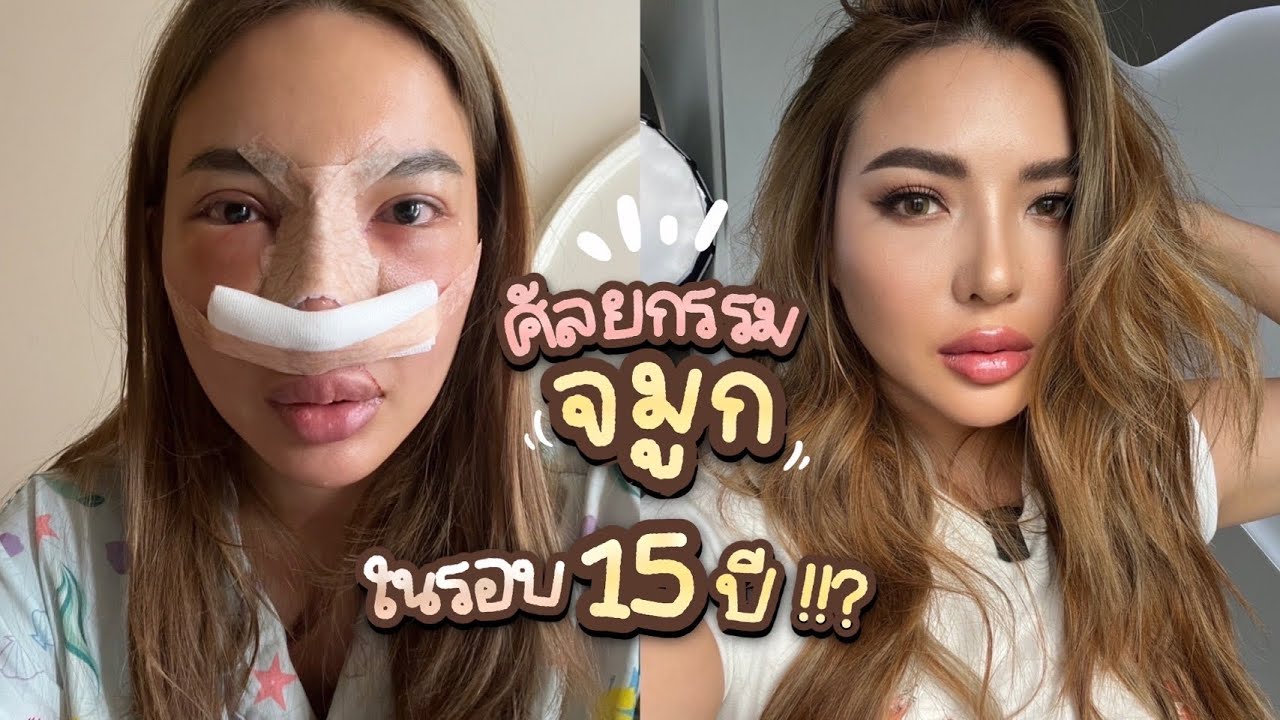 เกาหลีเกาใจ EP.15 ศัลยกรรมจมูกใหม่ ในรอบ 15 ปี ทำดีสวยชาติหน้า ทำหน้า ...