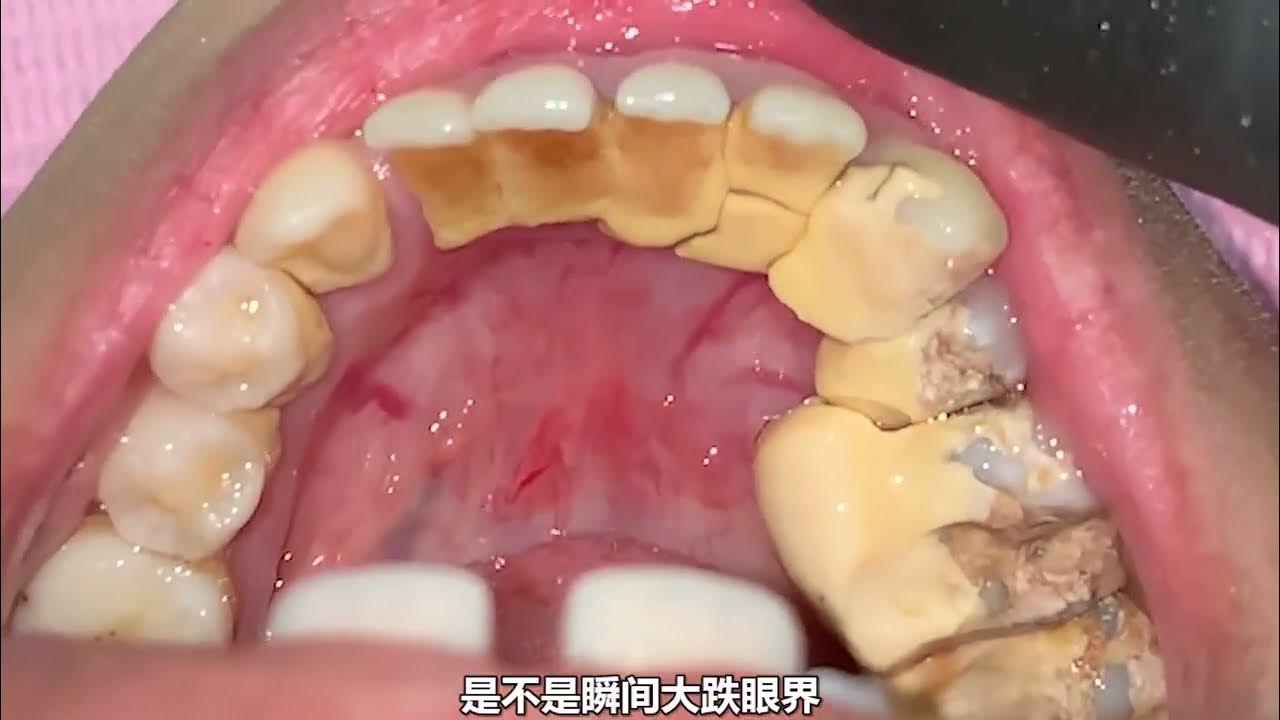Deep Cleaning With HEAVY Tartar Build Up At The Dentist 016 YouTube