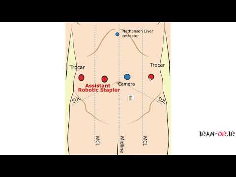 آموزش عمل جراحی اسلیو گاسترکتومی با دوبله فارسی