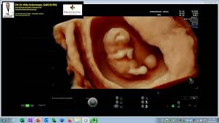10 Weeks Normal Pregnancy (Dr Wiku Andonotopo)