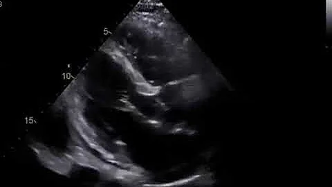 Echocardiogram after the initiation of chemotherap...