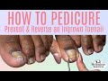 👣How to Avoid & Reverse an Ingrown Toenail with a Pedicure👣