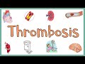 Thrombosis : Definition, Causes, Types, Morphology, Fate of a Thrombus & Clinical manifestations