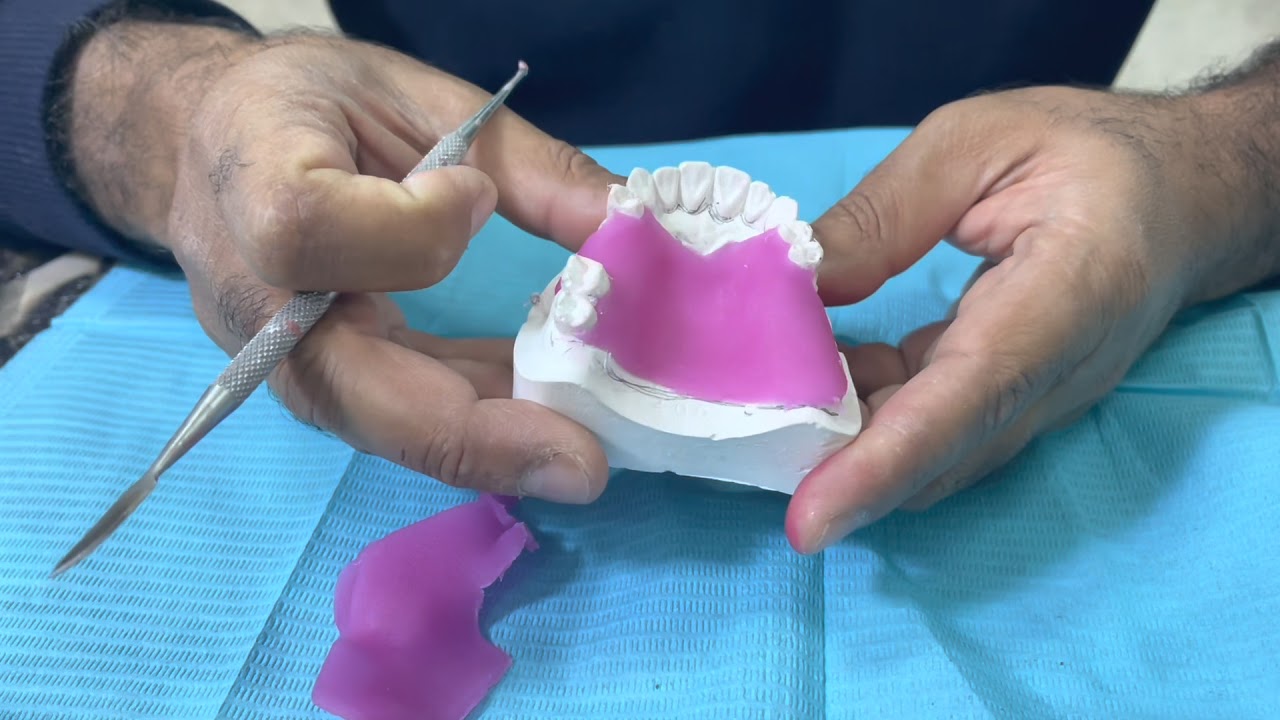 Construction of record base and bite rim for partially edentulous cast