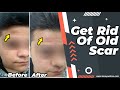 Old scar removal on forehead  deep scar removal  dr adarsh tripathi