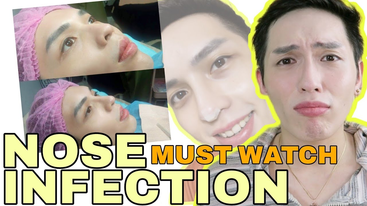 HIKO THREAD + NOSE FILLER INFECTION! RHINOPLASTY OR NONINVASIVE