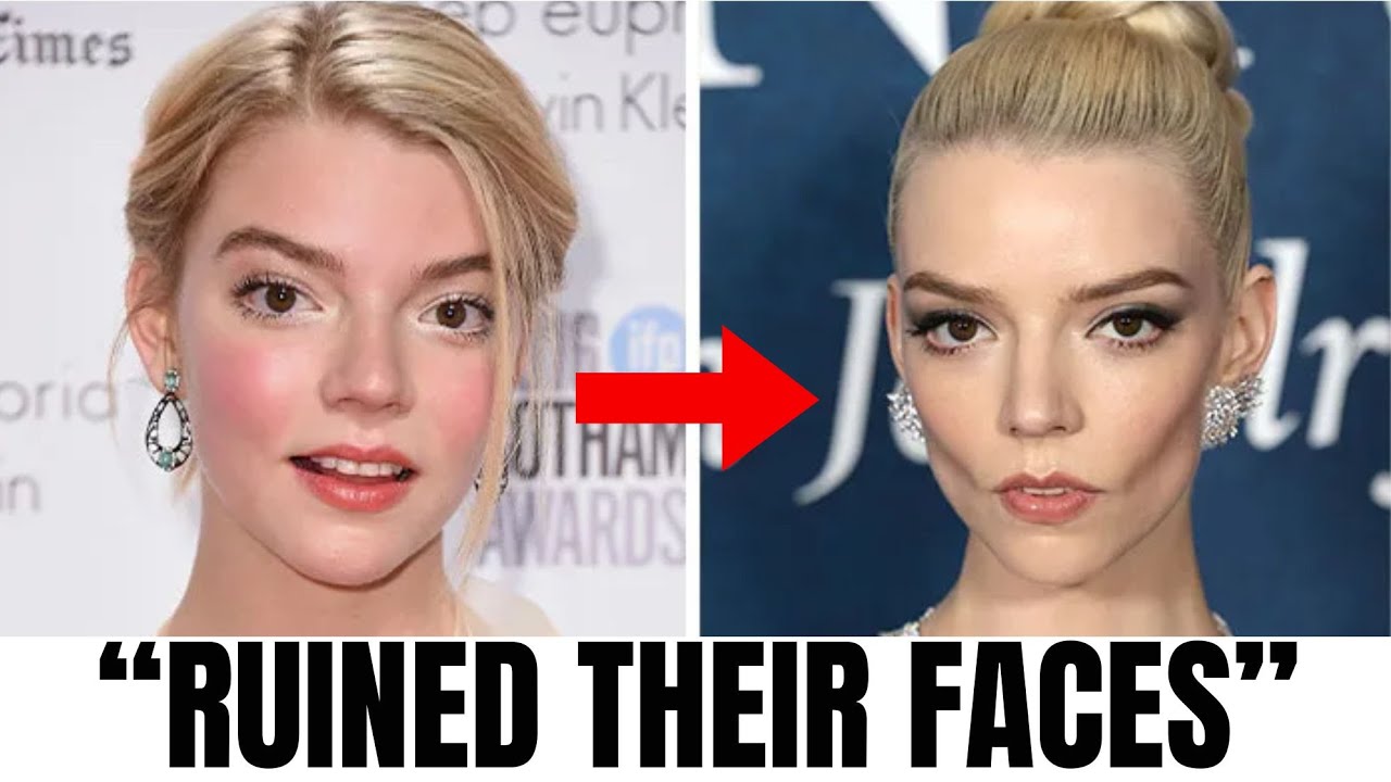 8 Hollywood Stars Regret Buccal Fat Removal