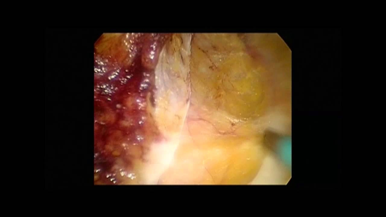 Endoscopic subcutaneous approach to component separation