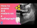 Radiographic Assessment of Third Molars | Wisdom Tooth Assessment