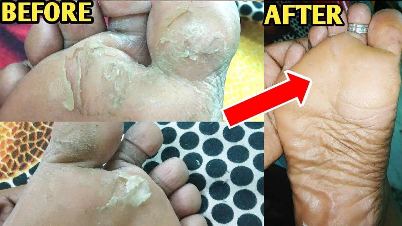 💯 Live result in 2mints Removing Hard Dead Skin from Foot Skin