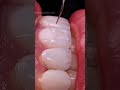 Perfect Smile Makeover | Artificial Teeth on Small Teeth | Beautiful Shiny Smile Transformation