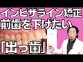 出っ歯のインビザライン矯正とにかく下げたい前歯をどうすればいいの？