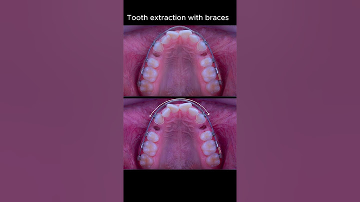 Don't worry about tooth extraction with braces #ardaarisan