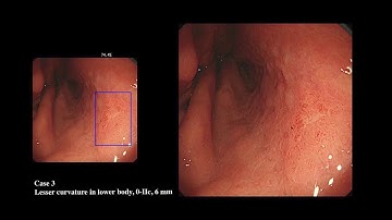 AI for early gastric cancer detection