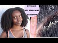 How to Cure Dry Scalp, Dandruff and Dry Hair| WEEKLY HAIR TIPS FOR FASTER HAIR GROWTH / HEALTHY HAIR