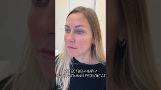Филлеры гиалуроновой кислоты/MediOk, ссылка для связи в шапке профиля #косметологмосква