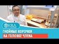 😟 Гнойные корочки на головке члена. Клинический случай №766