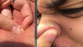 Best of POPPING!  Best of the ER's Best Pimple Pops and Comedones?