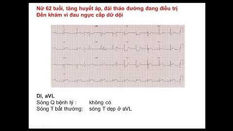 ECG 4 Nhồi máu cơ tim cấp thành dưới