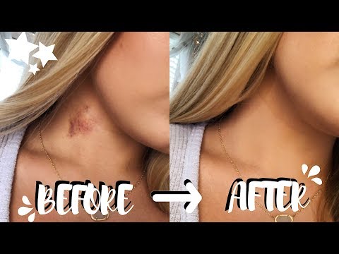 How To Get Rid Of Hickeys In Two EASY Steps! (no color correcting) | Brooklyn Anne