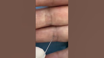 Dùng kim châm vào giúp đỡ tê bì tay