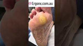 Forefoot Corn And Callus Removal By Podiatrist With Scalpel Undefined