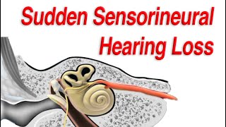 Sudden Sensorineural Hearing Loss: Diagnosis, Causes, and Treatment