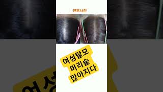 여성 가족력탈모. 40대 여성입니다. 가르마 부위가 앞쪽에서부터 정수리까지 모두 머리가 가늘어지면서 머리카락이 많이 빠졌습니다. 지금은 많이 촘촘하게 좋아졌습니다.