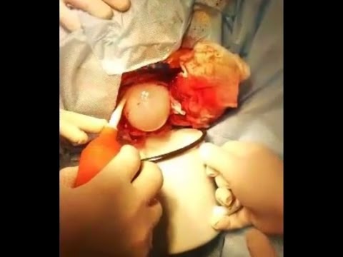Гигантская эхинококковая киста головного мозга