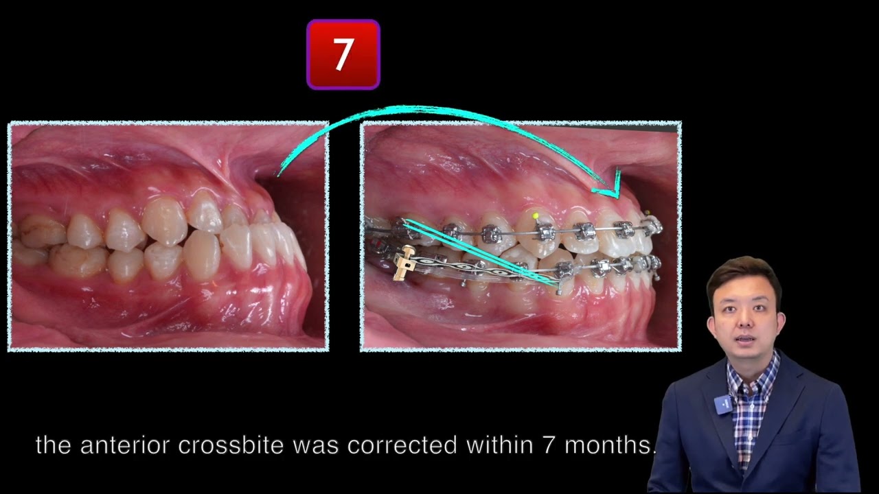 Severe Class III with -4 mm Overjet：OGS vs Ortho only｜【Chris