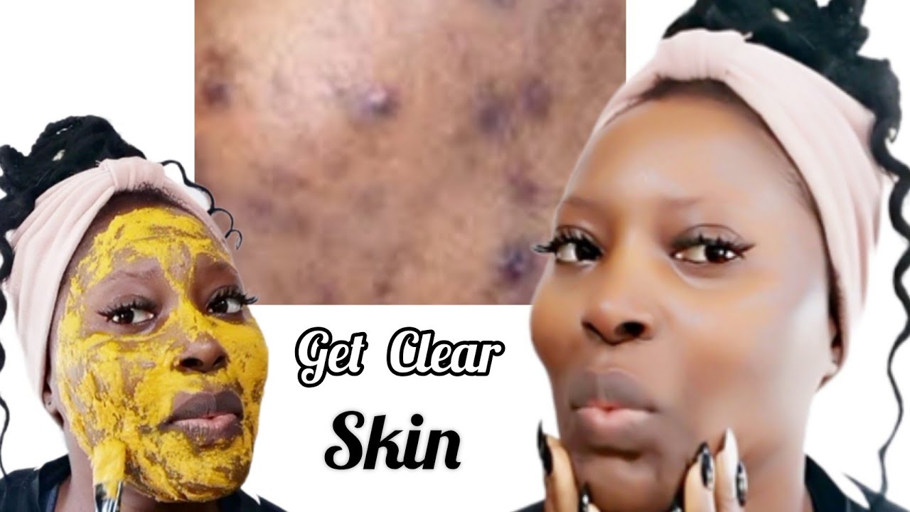 Skincare Turmeric Face Mask To fight Acne & Fade Away Scars / Get Clear ...