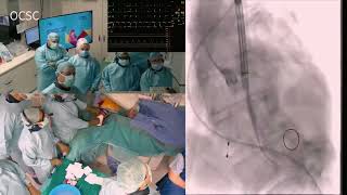 I. Kosmas | Case Live 3 | LIVE TAVR -Alternative access  Transmission Site: Onassis Hospital, Ca...