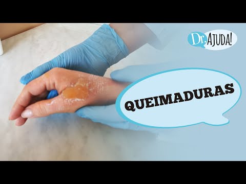 Vídeo: 3 maneiras de saber o grau de uma queimadura