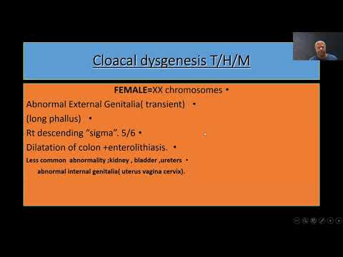 PRENATAL DIAGNOSIS OF ANAL ATRESIA/. Bronshtein Moshe