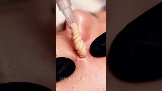 This Pore Was FULL… Vacuum Pulled EVERYTHING Out 😳 #asmr #blackhead #satisfying
