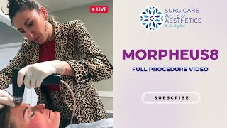 Morpheus8 - Full Procedure Video - Dr. Angelina Postoev