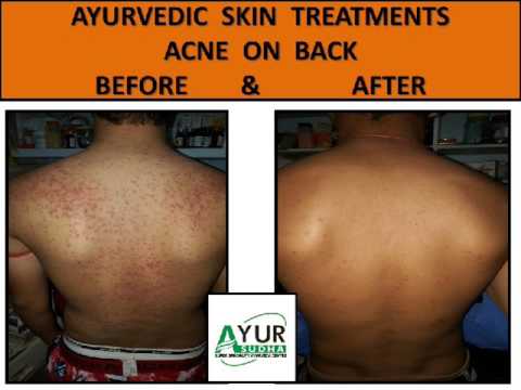 Acne - Pimples -Rosacea Ayurvedic Treatment II Best Skin Specialist  Doctor in Canada & India