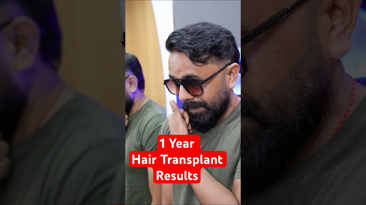 Hair Transplant Results in India | RQC Clinic | Surat 