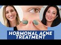 Treat Hormonal Acne with Spironolactone: A Dermatologist Explains | DERM CHAT