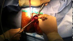 Hemorrhoids  Surgical Removal With Harmonic Scalpel