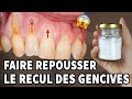 Incroyable il sagit dun remde  la maison pour la rcession gingivale