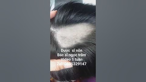 rụng tóc mảng. bé khang vĩ. video 1 tuần