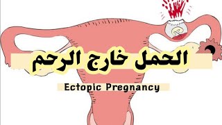 الحمل خارج الرحم Ectopic Pregnancy