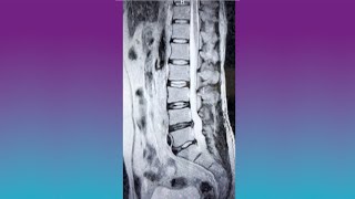 Disc Herniation Review with Dr. Giuffrida