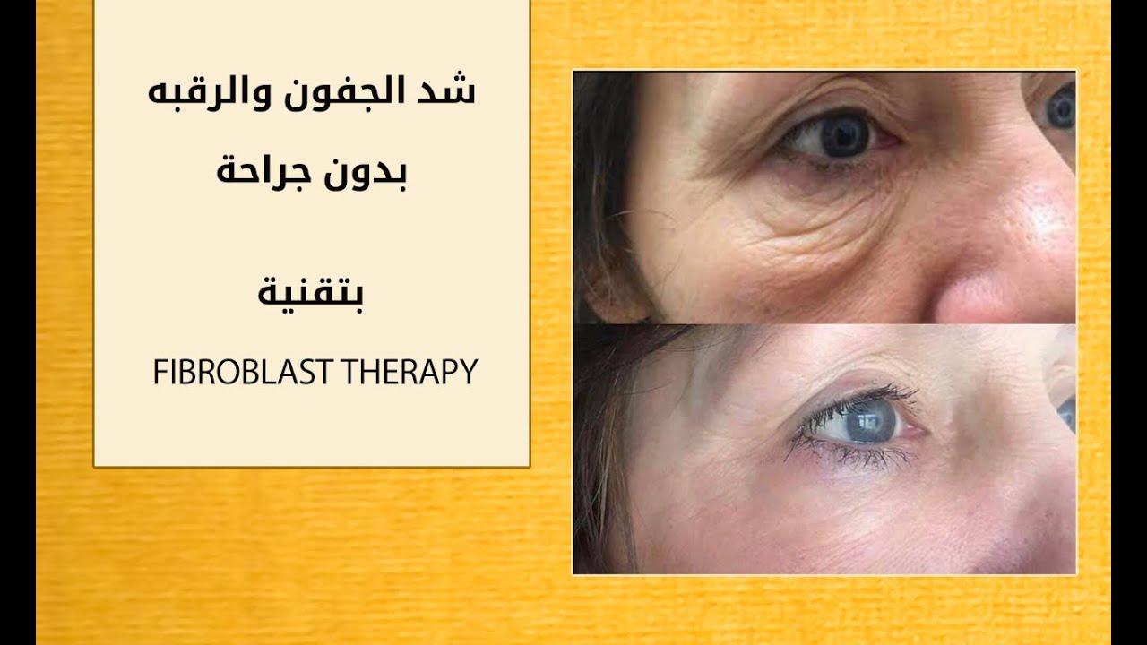 شد الجفون والرقبه بدون جراحه - FIBROBLAST THERAPY