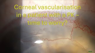 0030: Corneal vascularisation in a patient with a PK - time to worry?