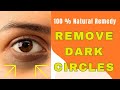 Remove Dark Circles Permanently in 1 Week- Best Home Remedy